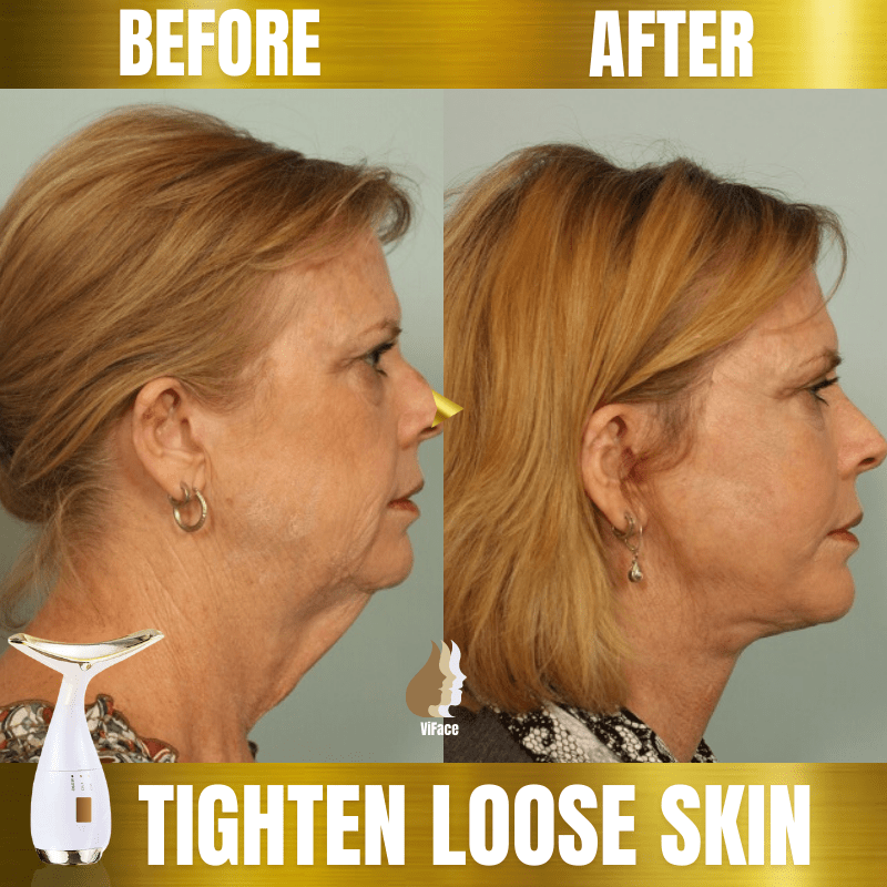 ViFace Ultrasonic Facial Lifting Massager - flowerence