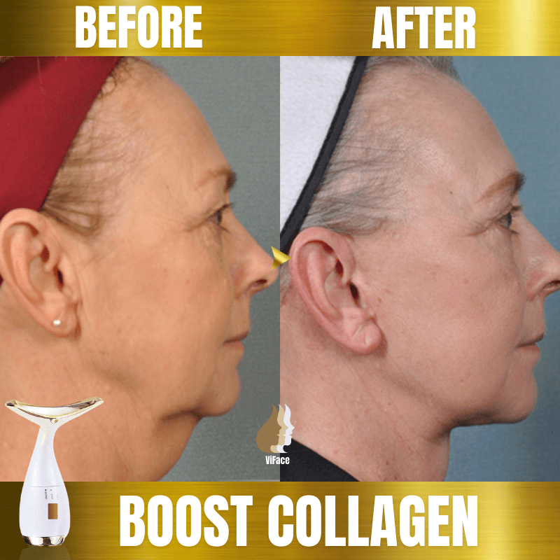 ViFace Ultrasonic Facial Lifting Massager - flowerence