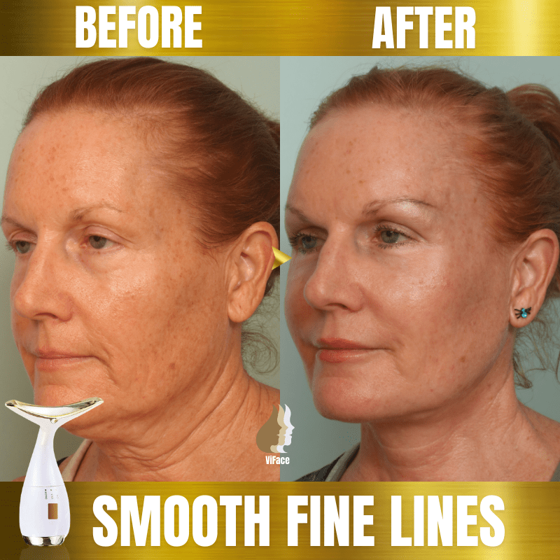 ViFace Ultrasonic Facial Lifting Massager - flowerence